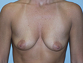 Patient # 36346 Before Photo # 1
